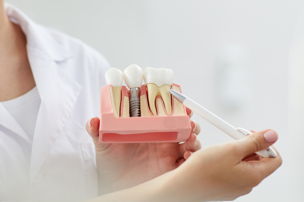 What is an Implant and what are the Implant Types?