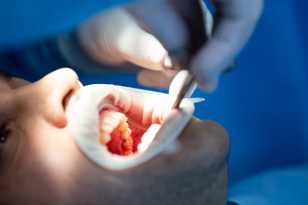 Ankara Orthodontics Polyclinic Gum Treatment