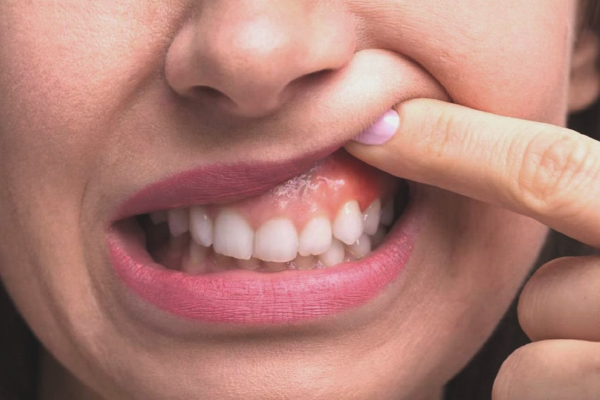 Diş Eti Hastalıkları (Periodontoloji)